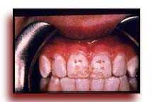Teeth with flouride decay present