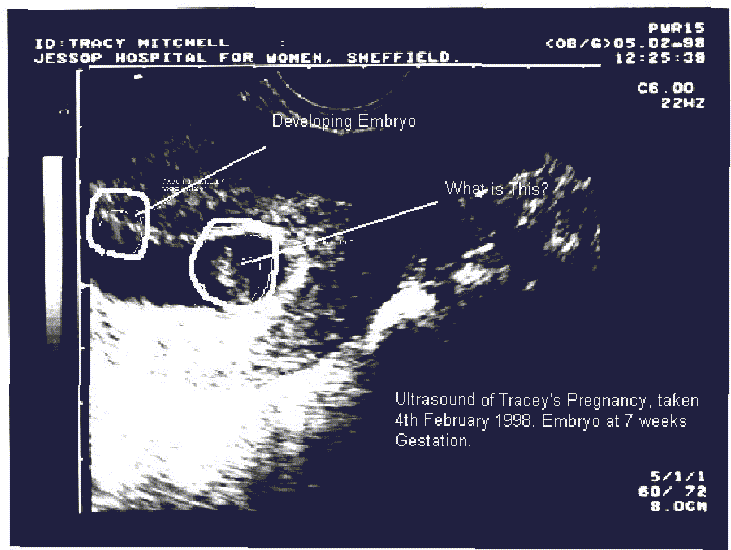 Ultrasound of implant